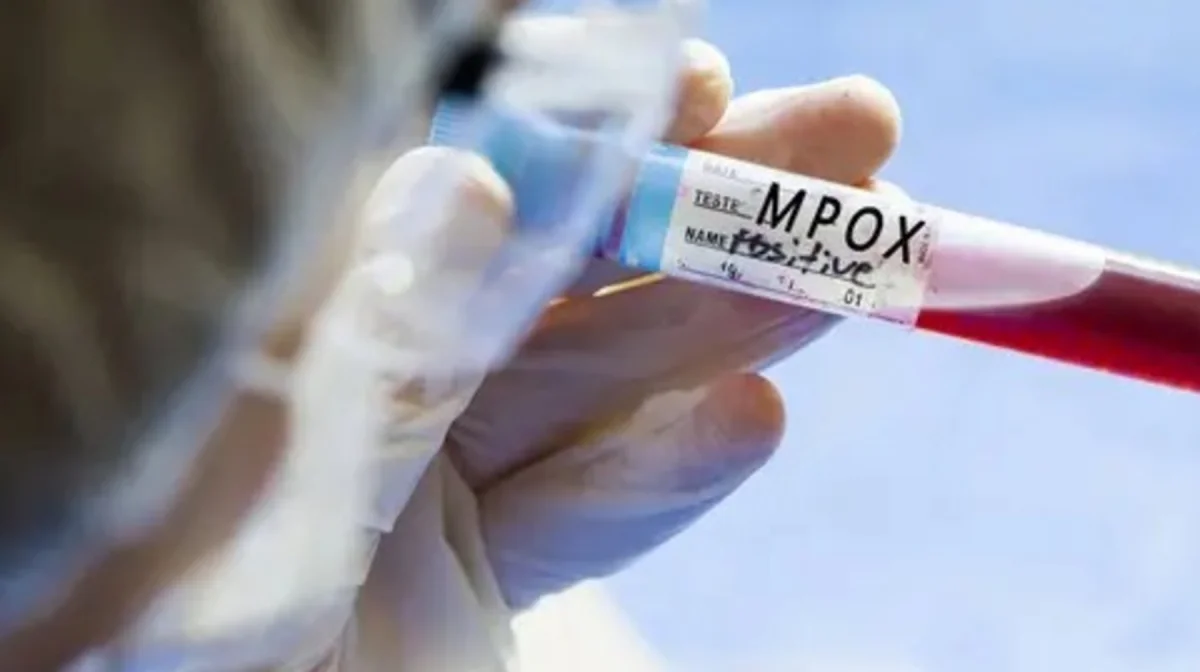 АҚШ-та маймыл шешегін адамға жұқтырудың алғашқы жағдайы анықталды