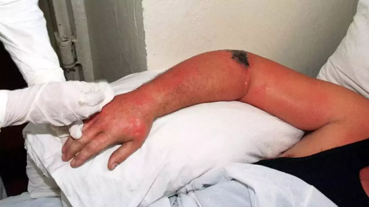 Аса қауіпті ауру: Шымкент сібір жарасын жұқтырған адам анықталды